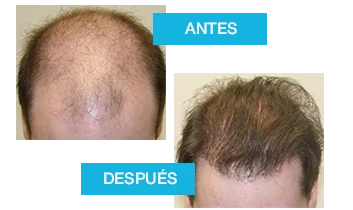 Profolan: antes y después de la recuperación capilar. Testimonios visuales.