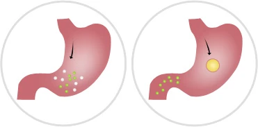Resultados de Silvets: Comparación antes y después del tratamiento para adelgazar.