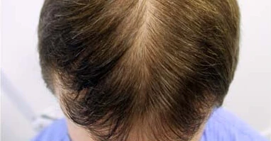 Primer mes con Profolan: inicio visible del crecimiento y reducción de la caída del cabello.